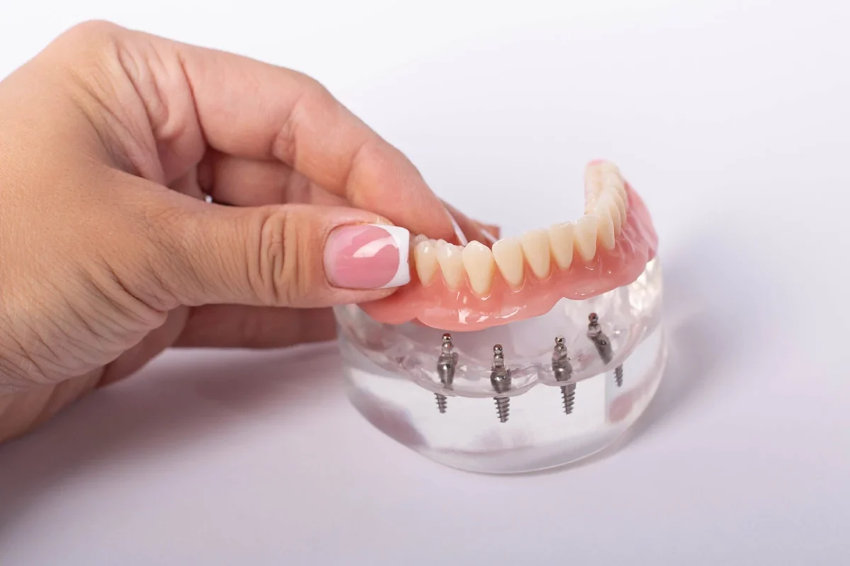 dental bonding Manhattan