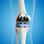 Knee-Replacement_1_533623-min.webp