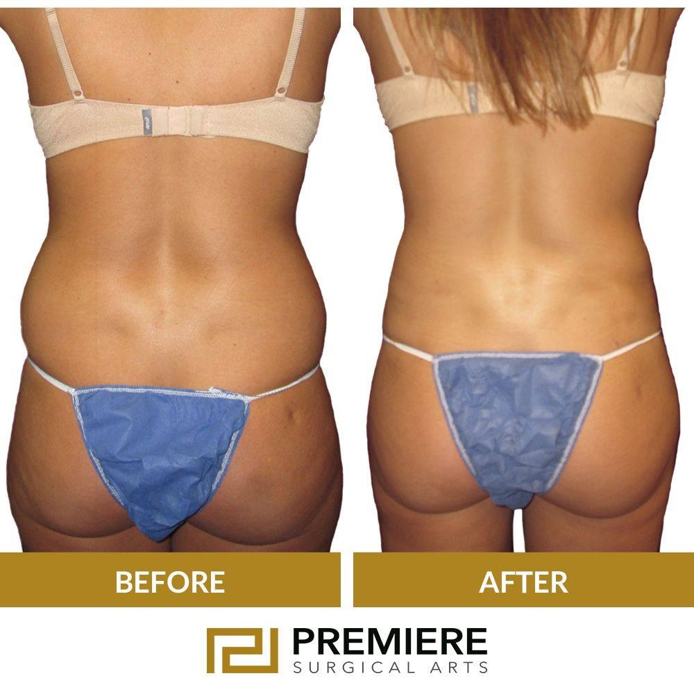 How Long Does Recovery Take After a Brazilian Butt Lift in Houston, Texas?