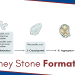 How-Are-Kidney-Stones-Formed.png