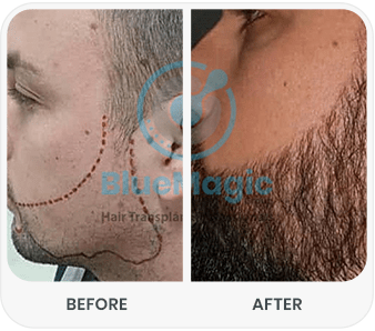 Everything You Need to Know About a Beard Transplant Everything You Need to Know About a Beard Transplant