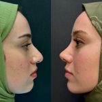 rhinoplasty-in-islamabad.jpg