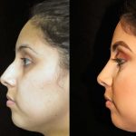 Before-and-after-results-of-rhinoplasty.jpeg
