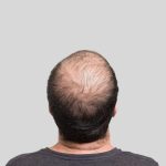 Hair-transplant-surgeon-in-islamabad.jpg