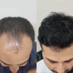 hair-transplant-i-islamabad.jpg