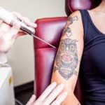 laser-tattoo-removal-in-islamabad.jpg