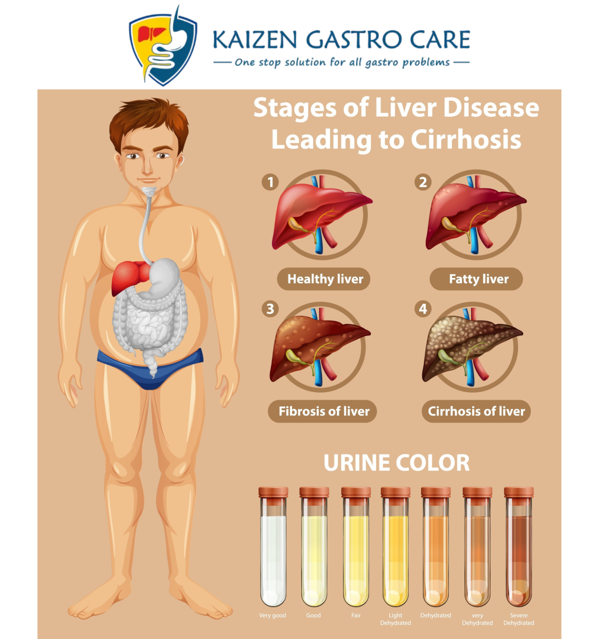 Advanced Liver Cirrhosis Treatment in Pune: From Medication to Modern Therapies