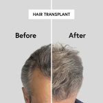 hair-transplant-i-islamabaddd.jpg