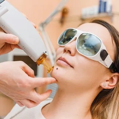 Safe Skin Procedures for Mole Removal