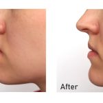Jaw-Surgery-in-Islamabad-2.jpg