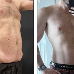 NPS_before-after-male-tummy-tuck-2.png