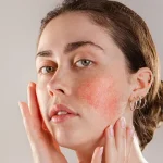 Rosacea-Harmony-.webp