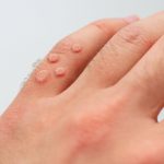Warts-removal-treatment-in-Islamabad-Pakistan.jpg