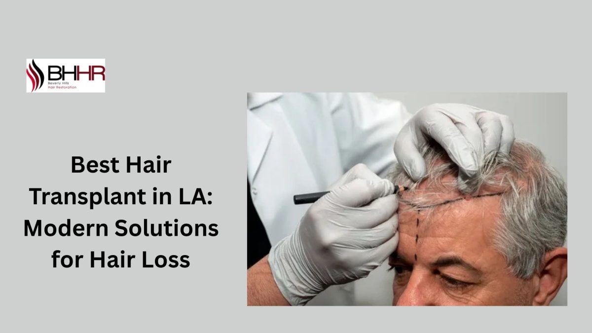 ¿Cuánto Cuesta un Trasplante de Cabello?