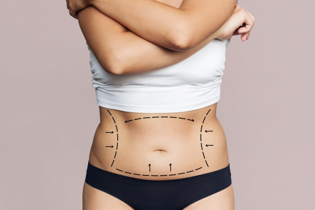 Liposuction in Islamabad and Fat Distribution Science
