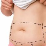 liposuction-surgery-in-islamabad.jpg