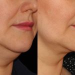 Double-Chin-Removal-in-Isl.jpg