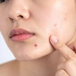 Acne_.jpg