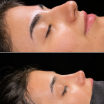 Before-After-Nose-Surgery.png