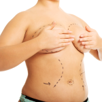 Breast-Augmentation-2000.png