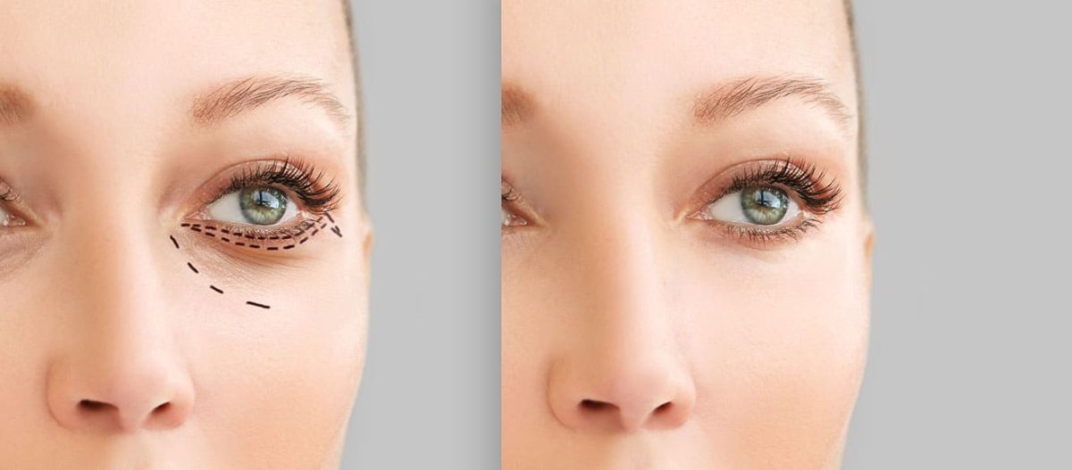 Eye Bag Removal in Dubai with Patient-Centered Care