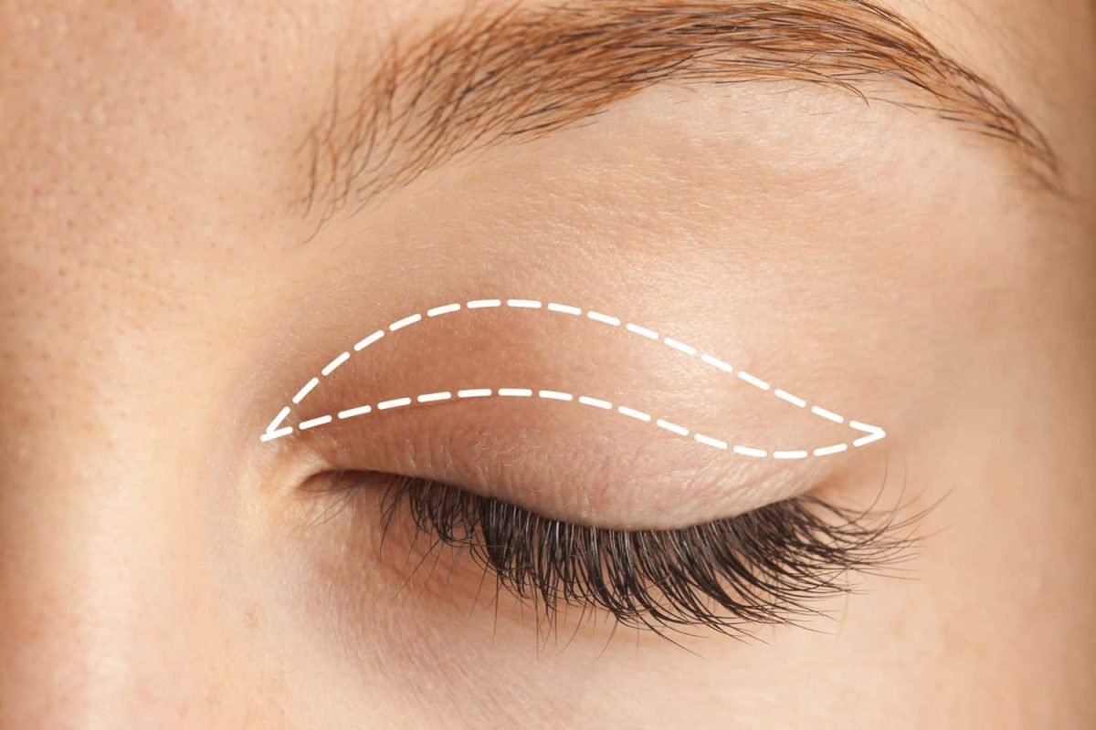 The Eye Transformation Journey: How Eyelid Surgery in Islamabad Enhances Facial Harmony