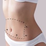 Liposuction-Surgery-.jpg