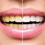 Teeth-Whitening-Treatment-in-Pune-at-Devs-Oral-Care-1024x682.webp