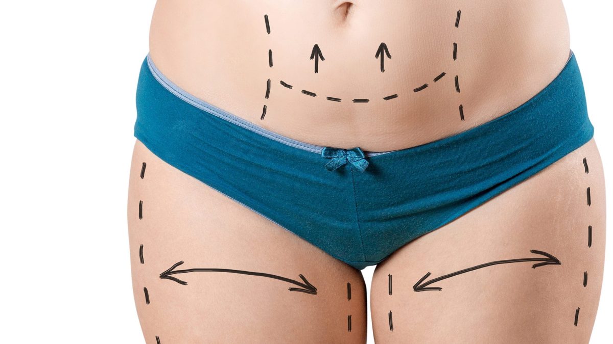 Liposuction in Islamabad: Redefining the Meaning of Personalized Body Transformation