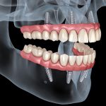 All-on-4-dental-implants-mockup-in-jaw-72005923.jpg