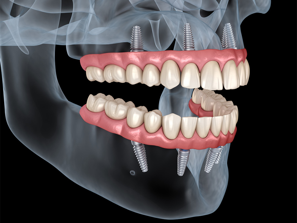 Restore Your Smile with All-on-X Implant Dentures in Houston and a Trusted Dental Implant Dentist in Houston