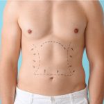 Liposuction-100000.jpg