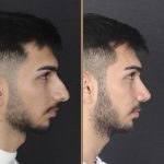 Rhinoplasty-surgery-cost-.jpg