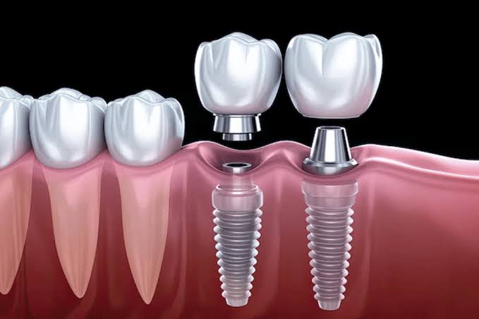 Affordable Dental Implants in Houston for a Confident Smile