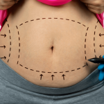 noninvasive-liposuction-768x538.png