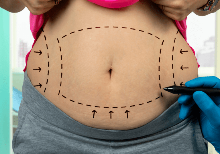 Liposuction Before and After Body Transformation Journey Liposuction Before and After Body Transformation Journey