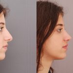 rhinoplasty.-_.jpg