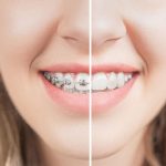 teeth-shifting-after-braces2-3081539907.jpg