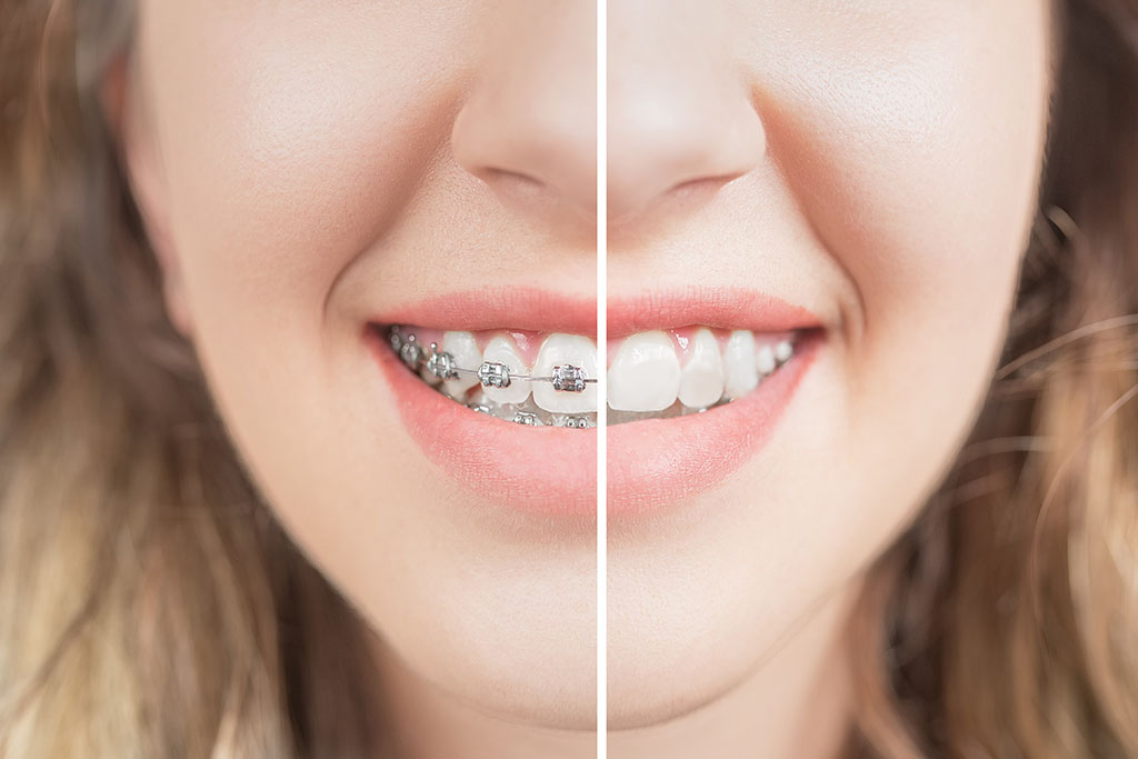 Expert Orthodontist and Braces Services in Elyson, TX