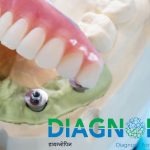 Full-Mouth-Dental-Implant-Diagnopein.jpg