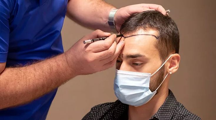 What Should You Expect from a Professional Hair Transplant Consultation?
