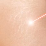 Top-3-Clinics-in-Dubai-for-Laser-Stretch-Marks-Treatment.jpg